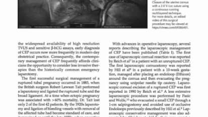 Robotic-assisted Laparoscopic Resection of Cornual Ectopic Pregnancy