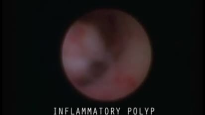 Inflammatory Polyp