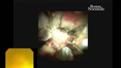 Fragmenting a Stone and Removing an Impacted Lithotripsy Basket Using the SpyGlass™ DS Direct Visualization System, by Todd Baron, MD