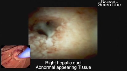 Diagnosing PSC Using Cholangioscopy, by Sri Komanduri, M.D.