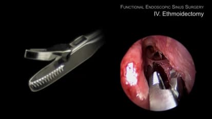Functional Endoscopic Sinus Surgery with Prof Stammberger