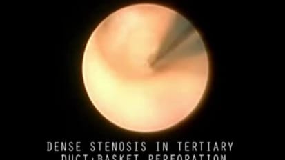 Using a Drill and Basket to Open a Severe Stenosis