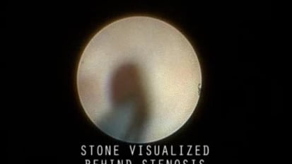 Visualizing a Stone Behind a Stenosis