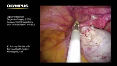 Laparo-Endoscopic Single-Site Surgery (LESS) Supracervical Hysterectomy with THUNDERBEAT and BiLL