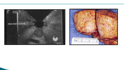 Biliary Metal Stent Bridge-to-Surgery, by V. Raman Muthusamy, MD