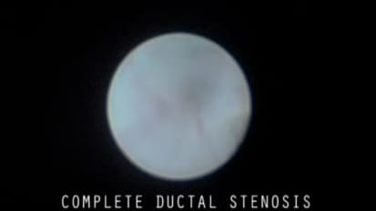 Complete Ductal Stenosis