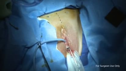Axis® Retropubic Sling with Diverticulum - Manish Patel, MD