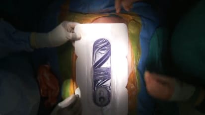 KCI Prevena™ Incision Management System: Sternotomy