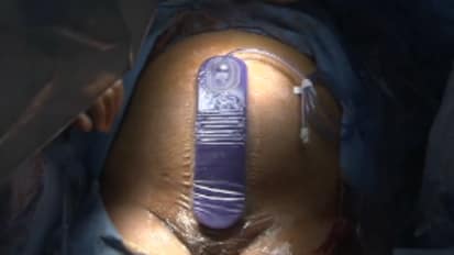 Prevena™ Incision Management System Application Technique