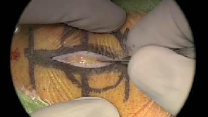 Endoscopic Microvascular Decompression for Trigeminal Neuralgia