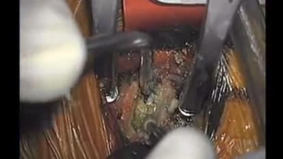 Dr. Ali Bydon Performs An ACDF Procedure