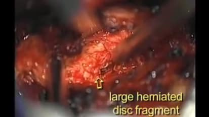 Dr. Ali Bydon Performs A Minimally Invasive Lumbar Discectomy