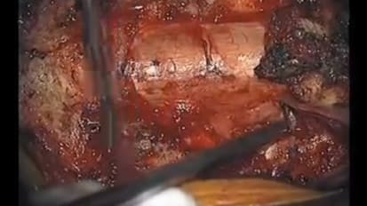  Dr. Ali Bydon Performs A Spinal Synovial Cyst Resection 