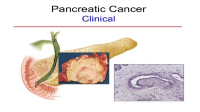 New Developments in Pancreatic Cancer Prevention and Detection Girish Mishra, MD 