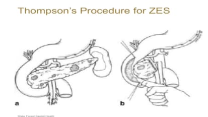 Surgical Management of Pancreatic Neuroendocrine Tumors Perry Shen, MD 