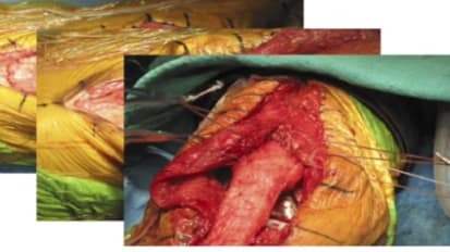 Extensor Mechanism Complications in Total Knee Arthroplasty