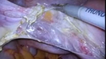 单点拉帕罗斯克超子切除术ENDOEYEFLEX5和THUNDERBEAT