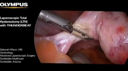 Total Laparoscopic Hysterectomy with THUNDERBEAT