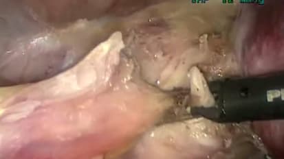 Total Laparoscopic Hysterectomy with PKS HALO and PKS Omni