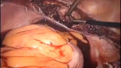 Total Laparoscopic Hysterectomy with PKS Omni