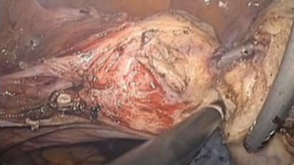 Laparoscopic Supracervical Hysterectomy with PKS Spatula