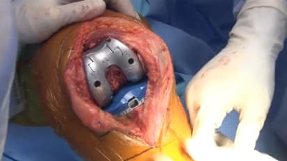 JOURNEY™ II Cruciate Retaining (CR) Knee System Surgery