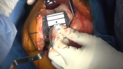 JOURNEY™ II BCS Bi-Cruciate Stabilized Knee System with Gap Balancing