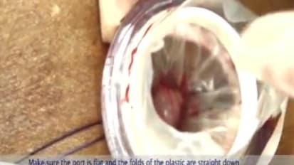 LESS Cholecystectomy Suggestions & Tips Step 3 - Inserting the TriPort+