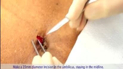 LESS Cholecystectomy Suggestions & Tips: Step 1 - Making the Incision
