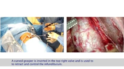 LESS Cholecystectomy - Recommended Standardized Approach of the Consortium on LESS Cholecystectomy