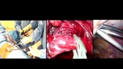 LESS Cholecystectomy Suggestions & Tips: Step 13 - Clipping the Cyst Duct and Artery