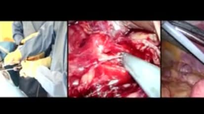 LESS Cholecystectomy Suggestions & Tips: Step 12 - Suction and Irrigation