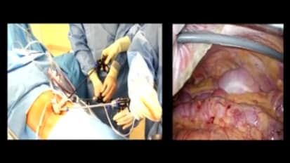 LESS Cholecystectomy Suggestions & Tips: Step 14 - Removing the Gallbladder from the Liver Bed
