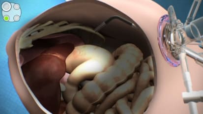 LESS Cholecystectomy Animation