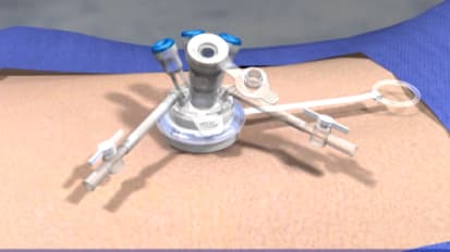 LESS Surgery Port Insertion Animation