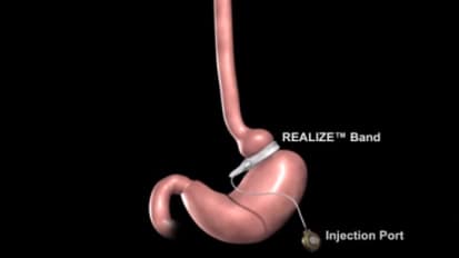  Gastric Band Procedure 