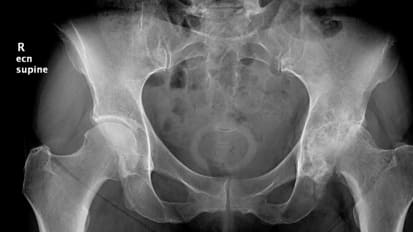 Minimally Invasive Posterior Approach Hip