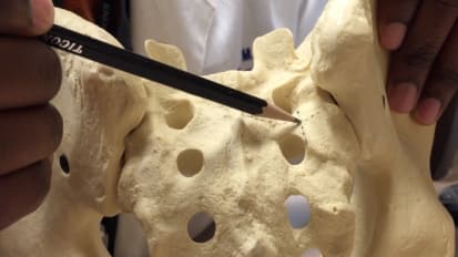 Pelvic Fixation with Sacral-Alar-Iliac Screws for Patients with Neuromuscular Scoliosis