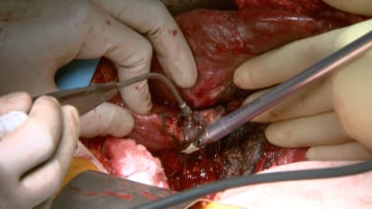 Segment V Liver Resection