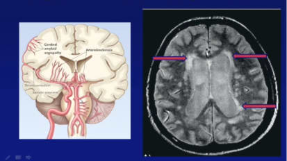 Abnormal Blood Pressure Regulation and its Consequences in Elderly People – Cardiology Grand Rounds