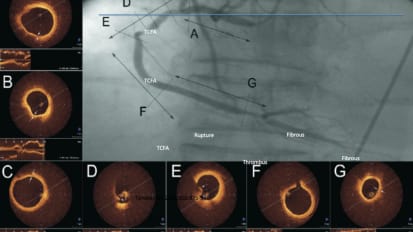 Culprit v Complete Revascularization for STEMI Patients: The Role of Invasive Coronary Imaging – Cardiology Grand Rounds