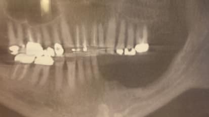 Case Study: Squamous Cell Carcinoma of Left Mandible Gingiva
