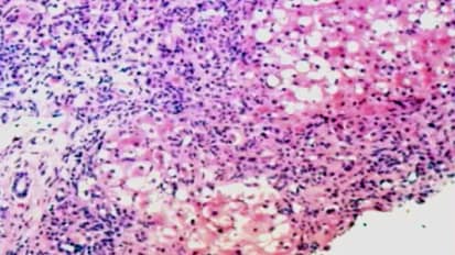 A Tale of Two Viruses: Recurrent Disease After Transplant