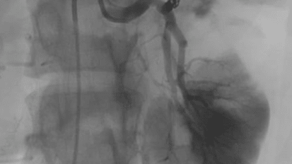 Abdominal Trauma: When to Call your Interventional Radiologist