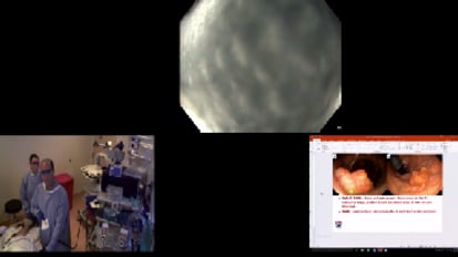 Live Case: Colorectal EMR for Adenoma with High-Grade Dysplasia in a Patient with Suspected Lynch Syndrome