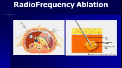 Hepatocellular Carcinoma: Optimal Treatment and Transplantation