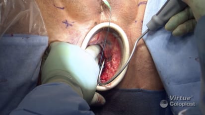 Advanced Procedures in Male Incontinence: The Virtue® Male Sling