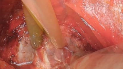 解剖激进前置术