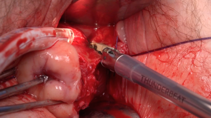 Vaginal Hysterectomy with THUNDERBEAT Open Extended Jaw