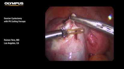 Ovarian Cystectomy with PK Cutting Forceps 